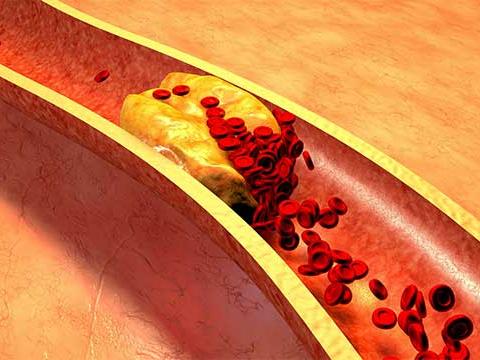 Portescap enhances atherectomy procedures for medical device manufacturer