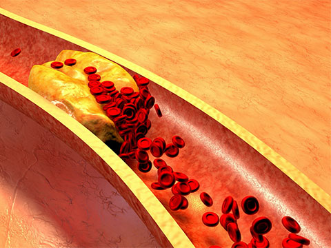 Coreless Brush DC Motor Powers Next-Gen Device for Brain Clot Removal