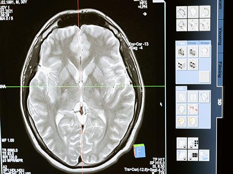 Motorisation drives transcranial magnetic stimulation treatment